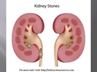 Types of Kidney Stones