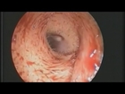 Woman discovers maggot living in her ear